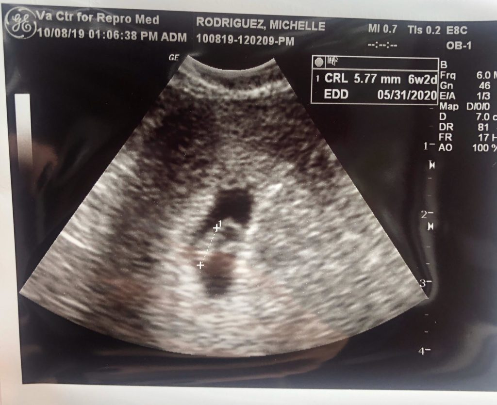 VCRM ultrasound confirmation scan